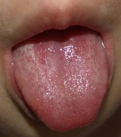 通过舌诊看儿童健康,小儿舌诊临床案例