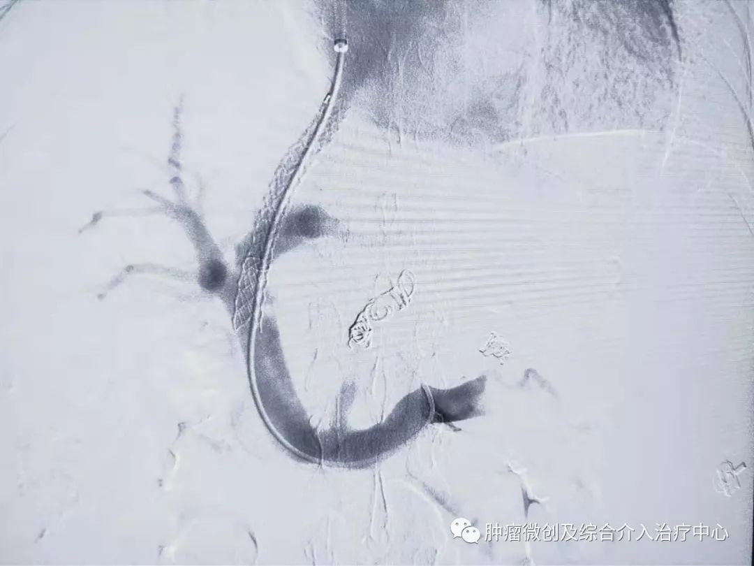 难治性消化道出血及难治性腹水的微创介入治疗-TIPS,运城市第一医院综合介入科