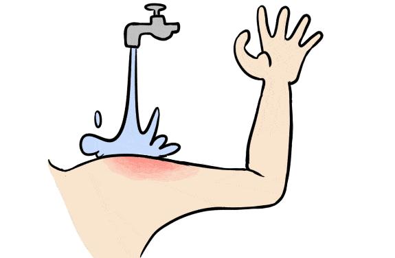 被艾滋病携带者咬了一口,该怎样处理?会不会被感染?