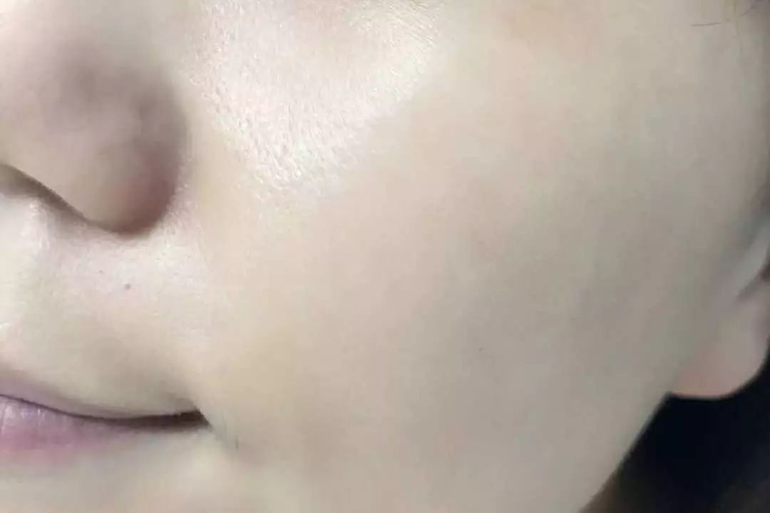 拯救毛孔黑头,清除黑头大毛孔的利器