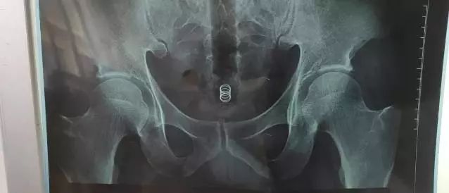 菊花一紧！男子洗澡摔倒，面霜棒插入肛门！进去容易出来难…