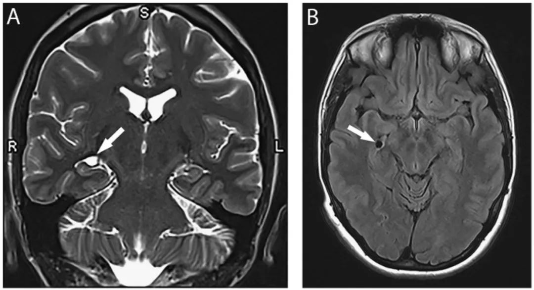 多图多表：带你识别颅内囊肿的影像学表现丨实战读片