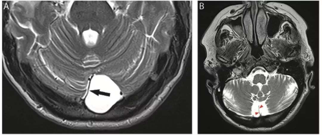 多图多表：带你识别颅内囊肿的影像学表现丨实战读片