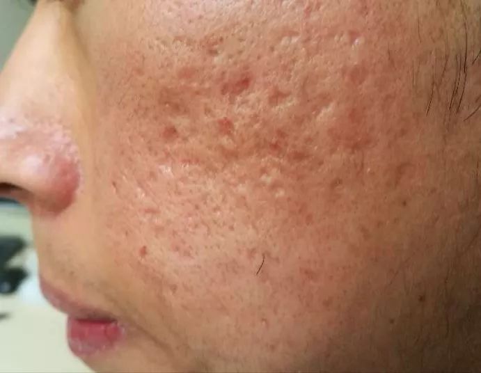 治痘痘和痘印痘坑哪个药膏好,脸上有痘痘痘印痘坑怎么去修复