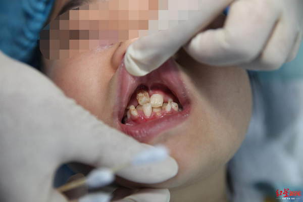 女孩确诊骨瘤妈妈发抖,10岁女孩鼻窦炎反复