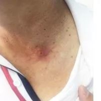 大人脖子上起了一片红色的颗粒,脖子上红色斑块起水泡