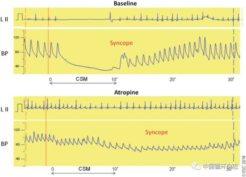 临床上晕厥的预防和处理,2022晕厥诊断与治疗指南