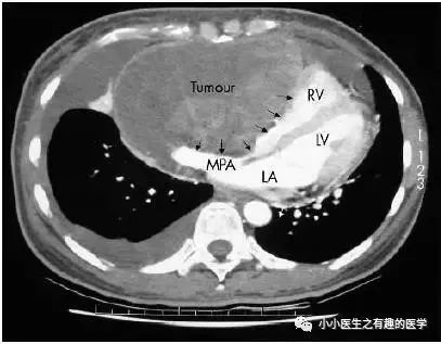 肺动脉分支充盈欠佳是肺栓塞吗,肺动脉缺损不可逆