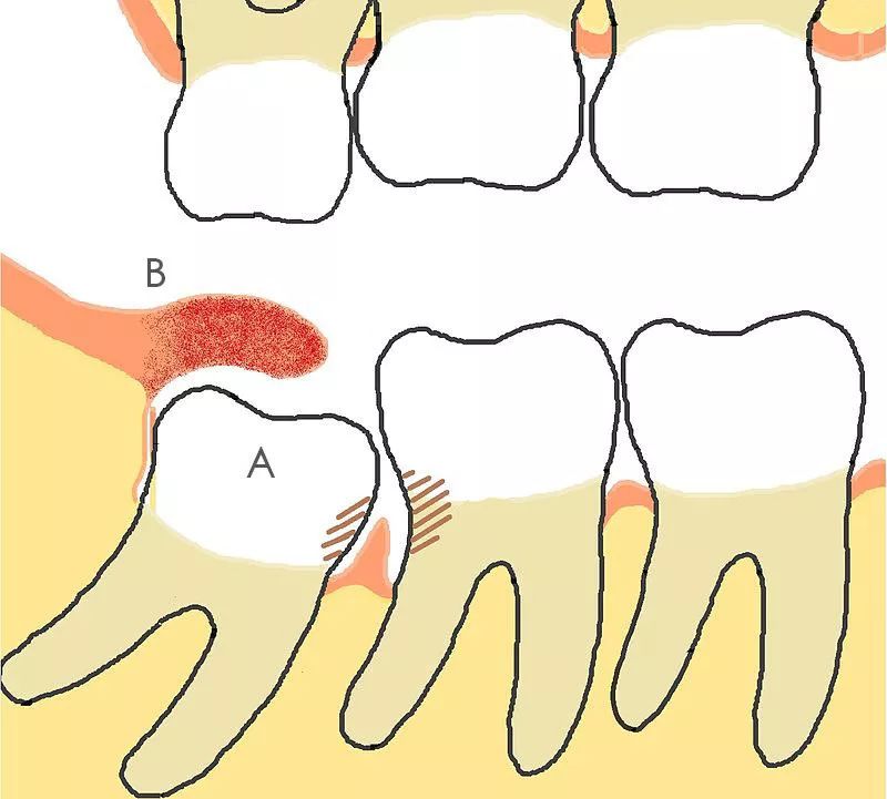 拔智齿为什么要用骨劈开术,智齿只剩牙根拔智齿的全过程