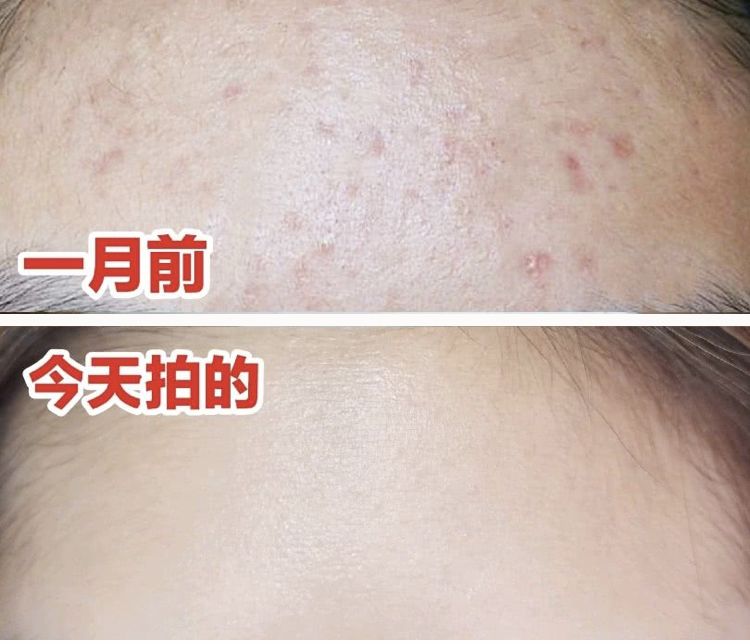 柔嫩抛光|脸上搓出3斤泥!难怪又黄又暗又黑头!10秒给脸蛋“剥壳”,厉害