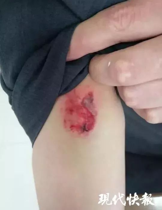 艾滋患者咬伤法官,艾滋病携带者咬伤法官