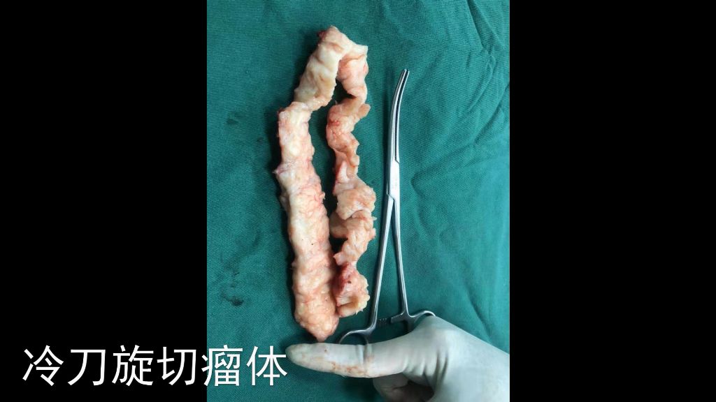 妇产科首例腹腔镜剔除子宫肌瘤,腹腔镜子宫肌瘤11厘米剔除术