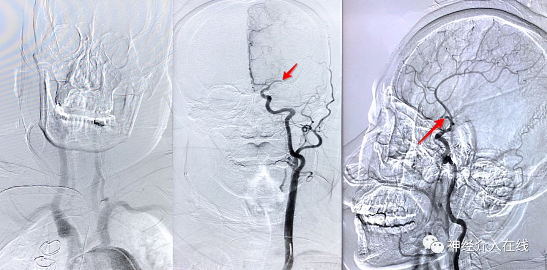 旭日东升第三式,旭日东升第三部