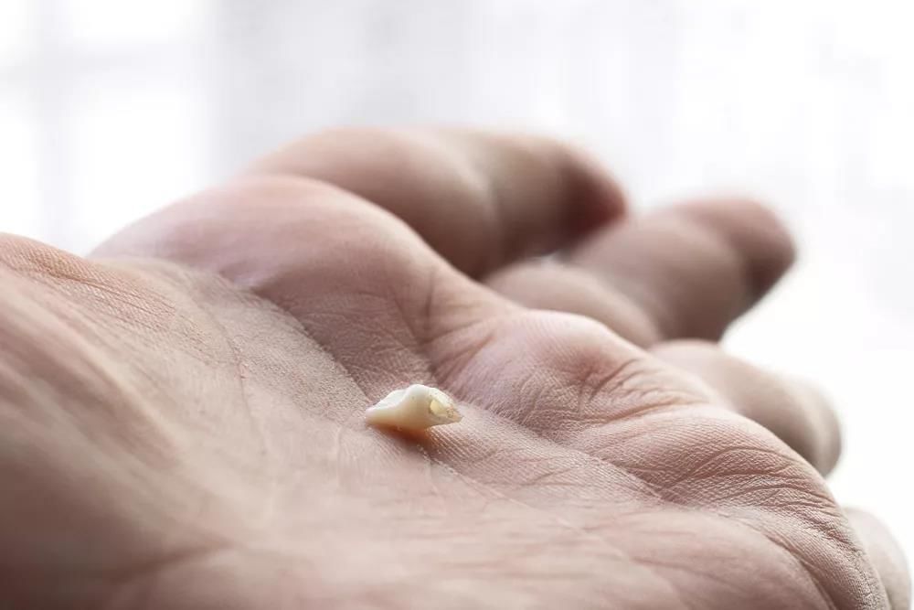 牙缺口长了一块硬东西,牙颈部有折裂线