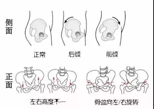 骨盆对男性的影响,骨盆对于腹肌的影响