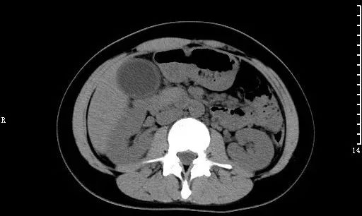 急诊科常见急腹症观察,腹部急诊影像大全值得收藏