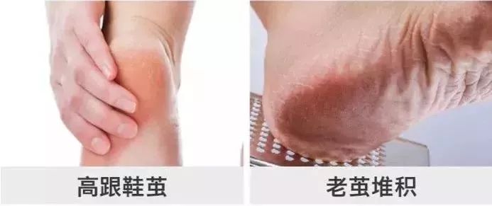 治脚气干裂起皮用什么药膏,有这个方子来治脚气就不怕复发