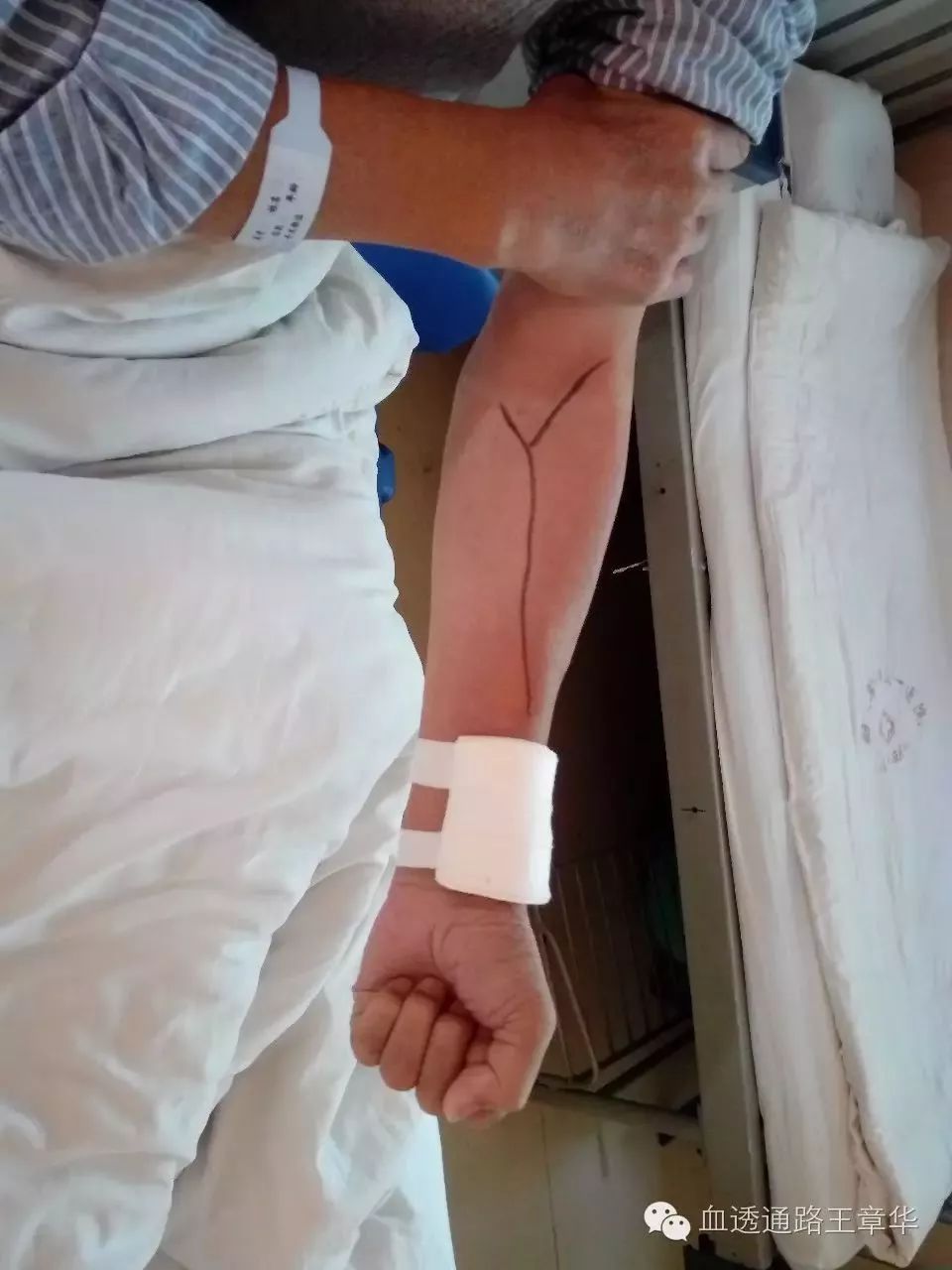 自体动静脉内瘘术后护理,自体动静脉内瘘术后2周锻炼方法