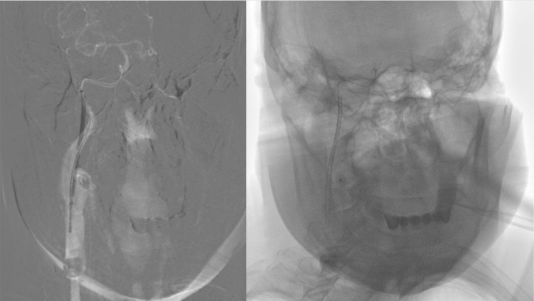 颈内动脉闭塞先进治疗,颈内动脉闭塞开通术病例讨论