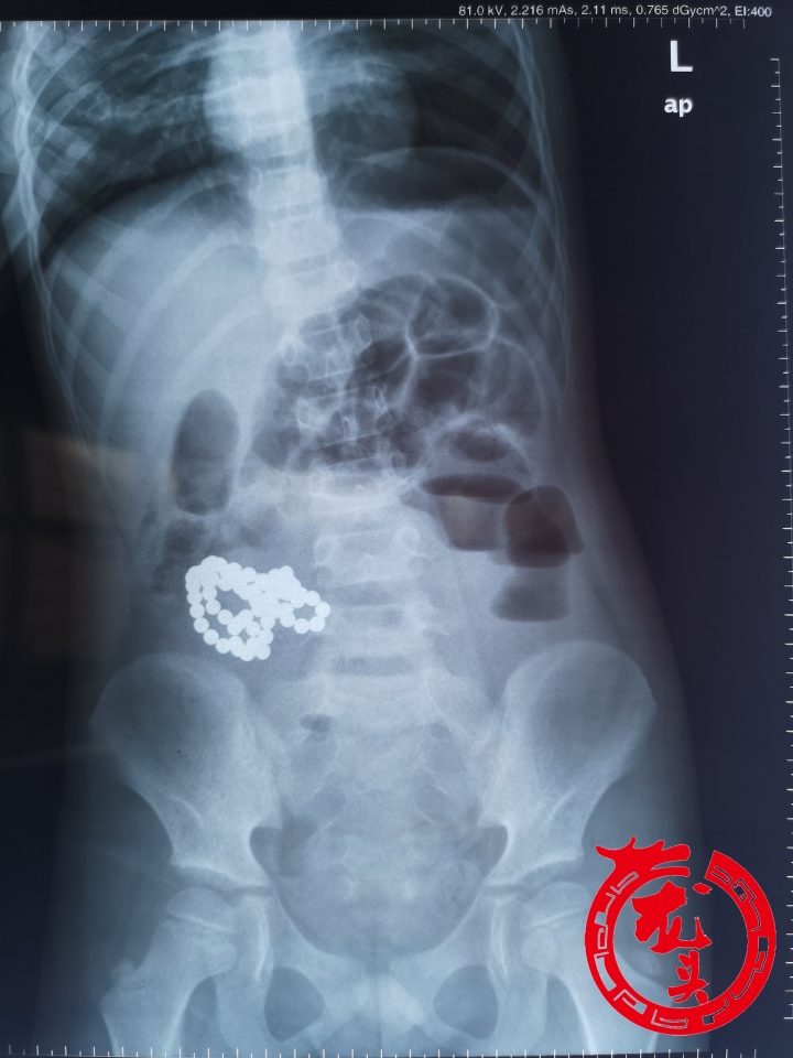 6岁男孩误食巴克球,11岁误食三颗巴克球怎么办