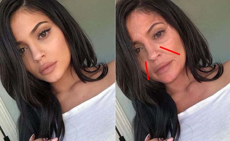 消除眉间法令纹最有效的方法,眉间纹和法令纹医美