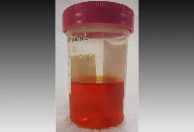 尿液各种颜色都代表什么病,尿液是五颜六色的怎么回事