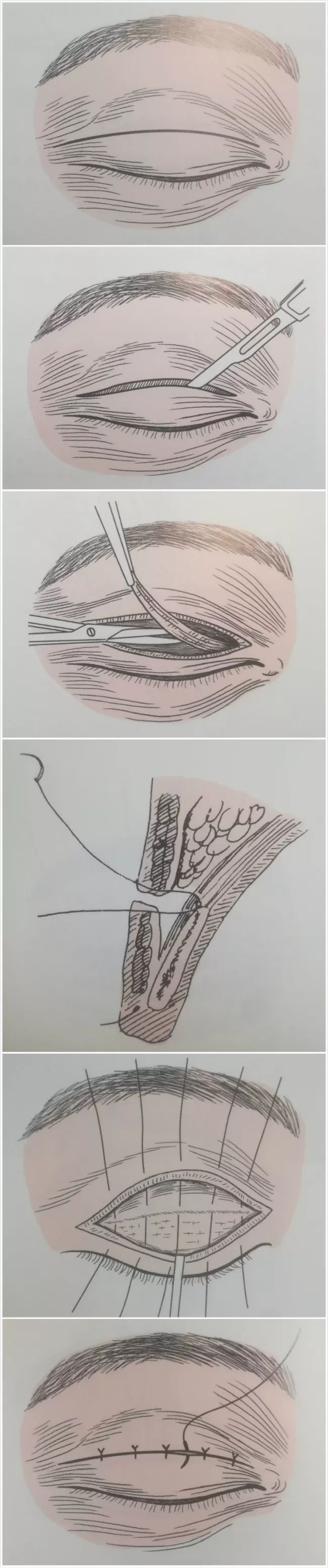 女明星同款双眼皮,明星同款双眼皮都有哪些