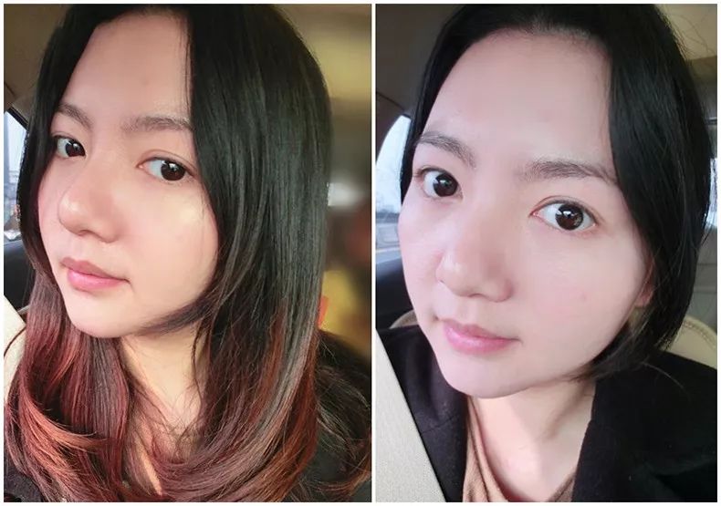 痘痘闭口里面有油脂,鼻子上的痘痘是青春痘还是粉刺