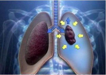 肺组织压缩约10%需要住院吗,肺组织压缩50%复发可能性