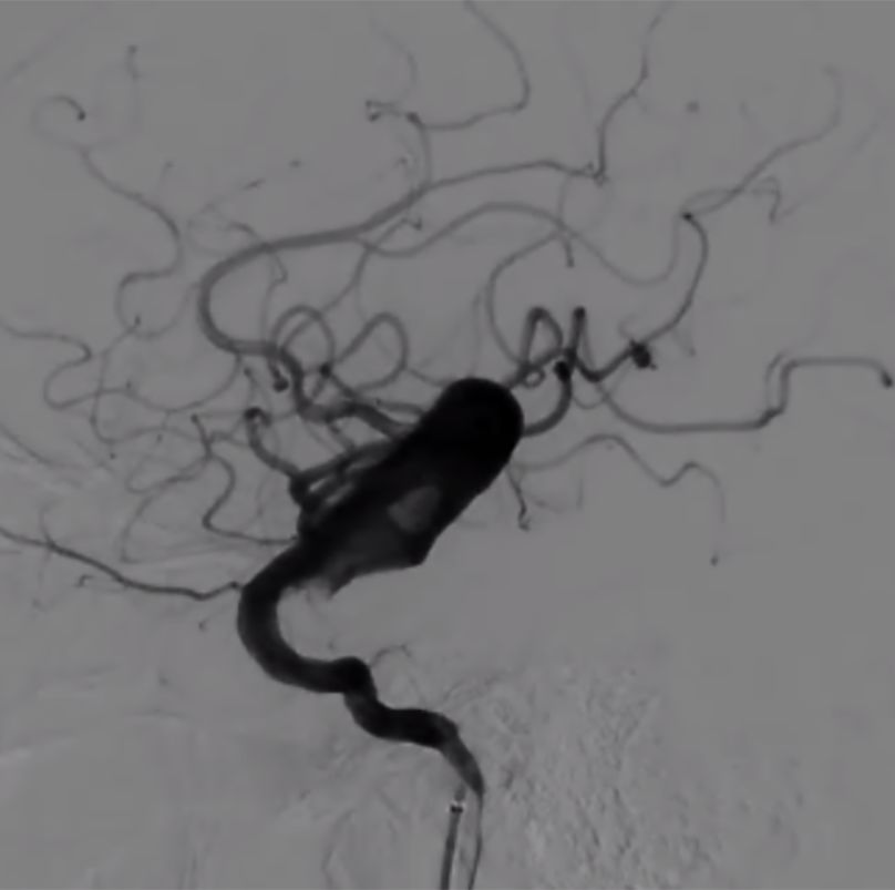 物华天宝·第7期｜脑部长型巨大夹层动脉瘤的4个密网支架桥接治疗复查治愈（附复查CTA结果）