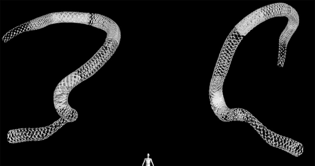 物华天宝·第7期｜脑部长型巨大夹层动脉瘤的4个密网支架桥接治疗复查治愈（附复查CTA结果）