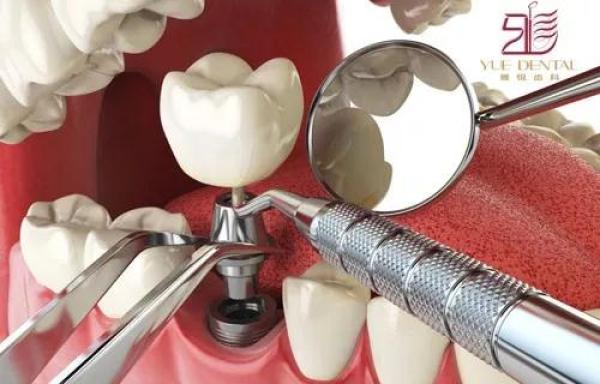 种牙钜惠丨十项费用全免！进口种植牙低至4999！大“齿”度福利来