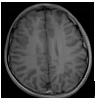 Rasmussen脑炎、结核性肉芽肿、脑发育性静脉畸形丨3分钟读片·第13期,下）