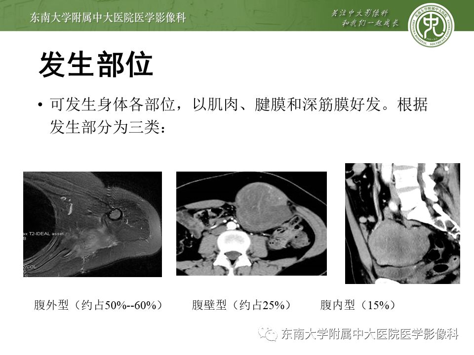 侵袭性纤维瘤影像学表现,侵袭性纤维瘤病影像上易诊断吗