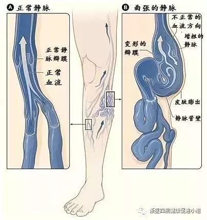 静脉曲张怎么保护好腿,夏季静脉曲张护腿