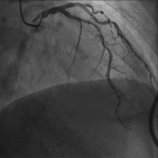冠脉造影技术成熟不,跟我学技术分析从入门到精通