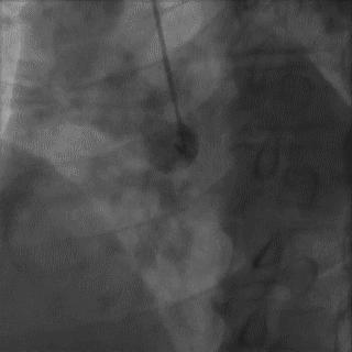 冠脉造影技术成熟不,跟我学技术分析从入门到精通