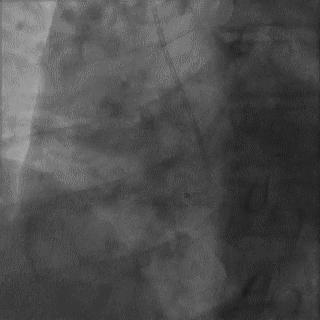 冠脉造影技术成熟不,跟我学技术分析从入门到精通