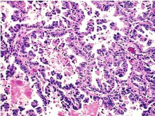 甲状腺微小癌如何确诊,甲状腺微小乳头状癌能治好吗