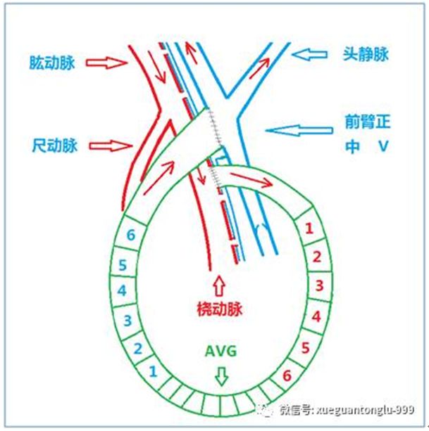 血透动静脉内瘘手术三种术式图解,血透室动静脉内瘘穿刺及护理