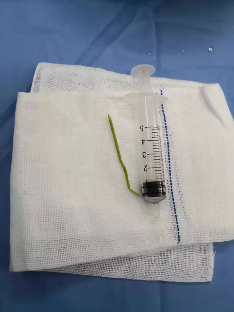 看着就疼!11岁男孩觉得要害部位不适,竟取出一根草