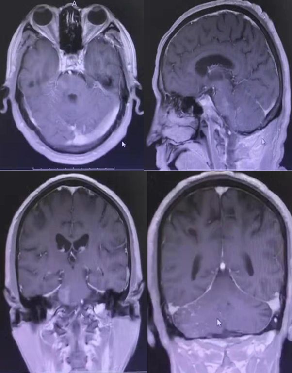 平山病、MELAS、MVNT、ODS丨3分钟读片·第15期