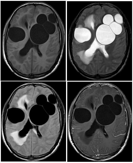 平山病、MELAS、MVNT、ODS丨3分钟读片·第15期