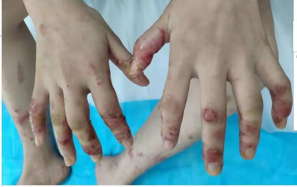 19岁女孩天天吃鱼，竟导致手脚“满目疮痍”！医生一句话道出真相