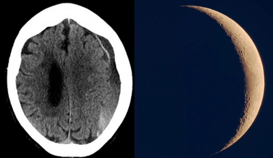 慢性硬膜下血肿会复发吗,慢性硬膜下血肿为什么容易复发