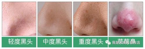 画面极度舒适！十几年顽固老黑头，30秒彻底连根拔起！毛孔畅快呼吸原来是这种感觉