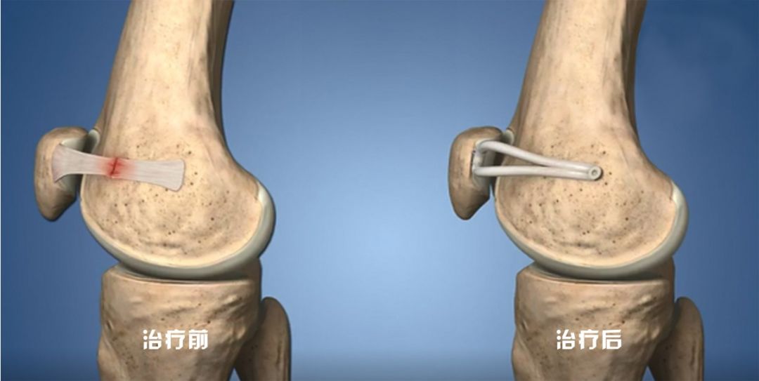 摔了一跤骨裂要做微创手术,摔一跤脚骨折手术