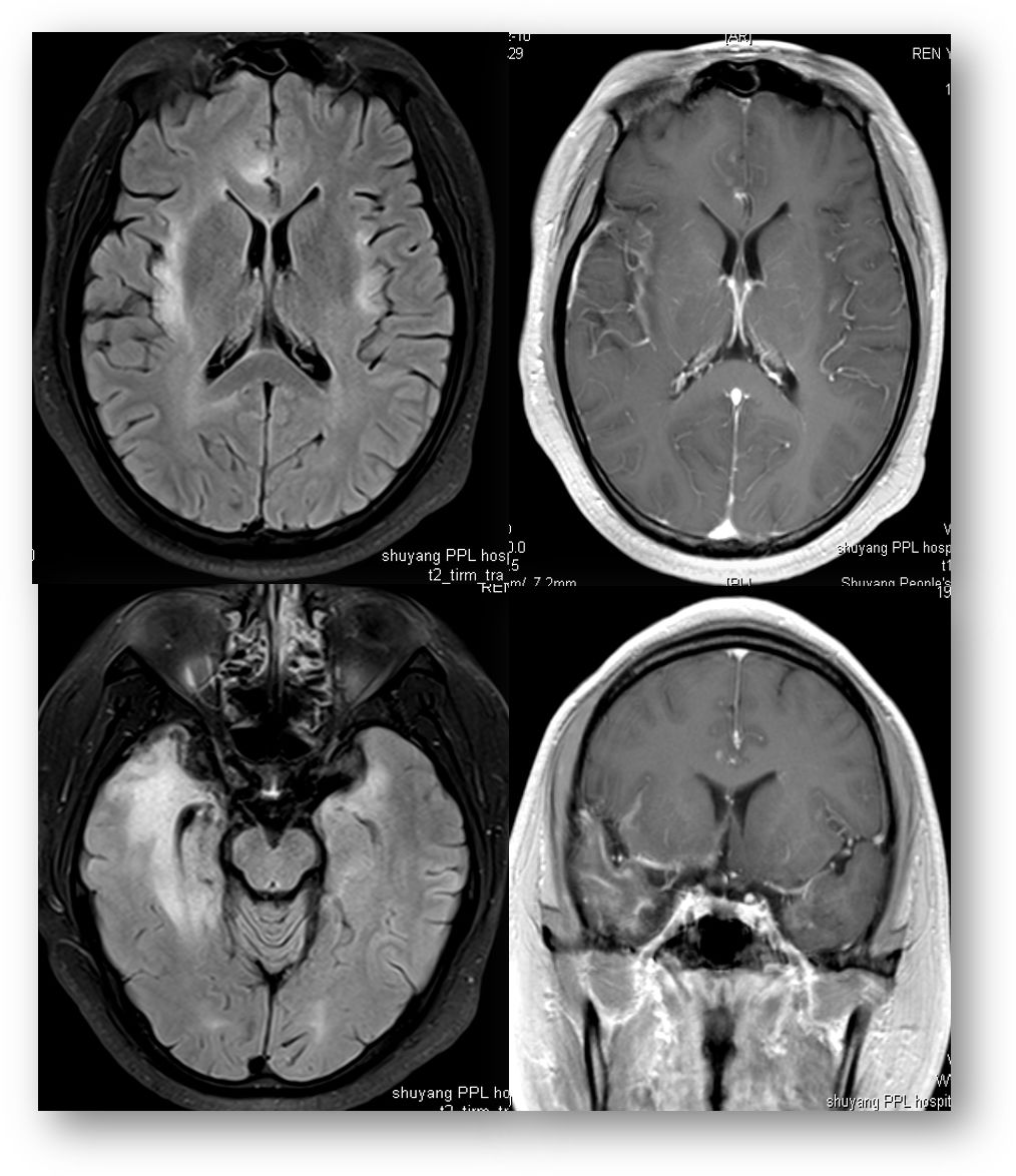 Whipple病、纹状体手、神经结节病、脱髓鞘假瘤丨3分钟读片·第16期