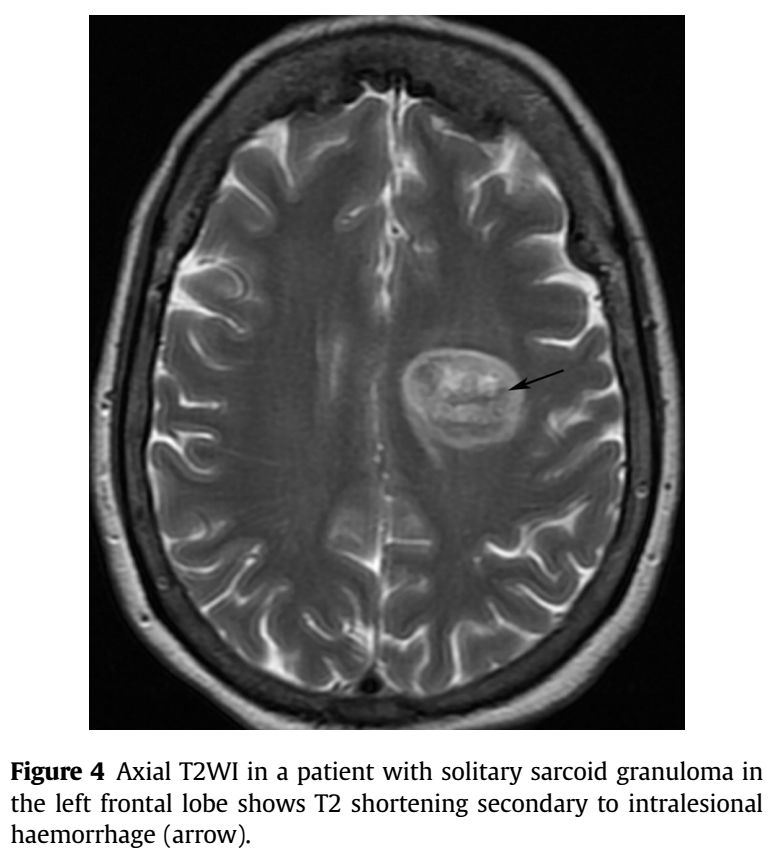 Whipple病、纹状体手、神经结节病、脱髓鞘假瘤丨3分钟读片·第16期