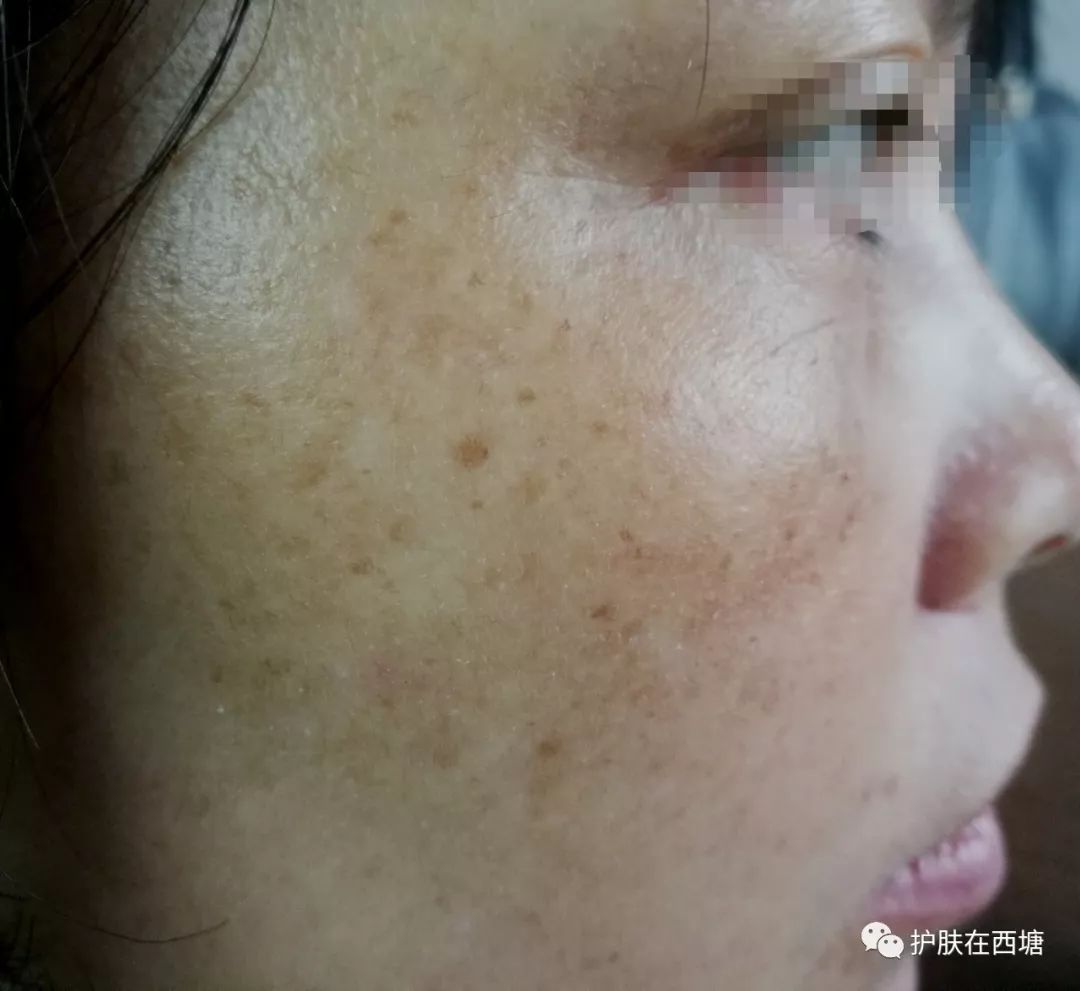 如何祛色斑推荐护肤品,这几个护肤小习惯可以淡化色斑